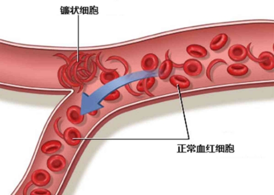 镰状细胞