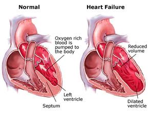 Comparation of heart